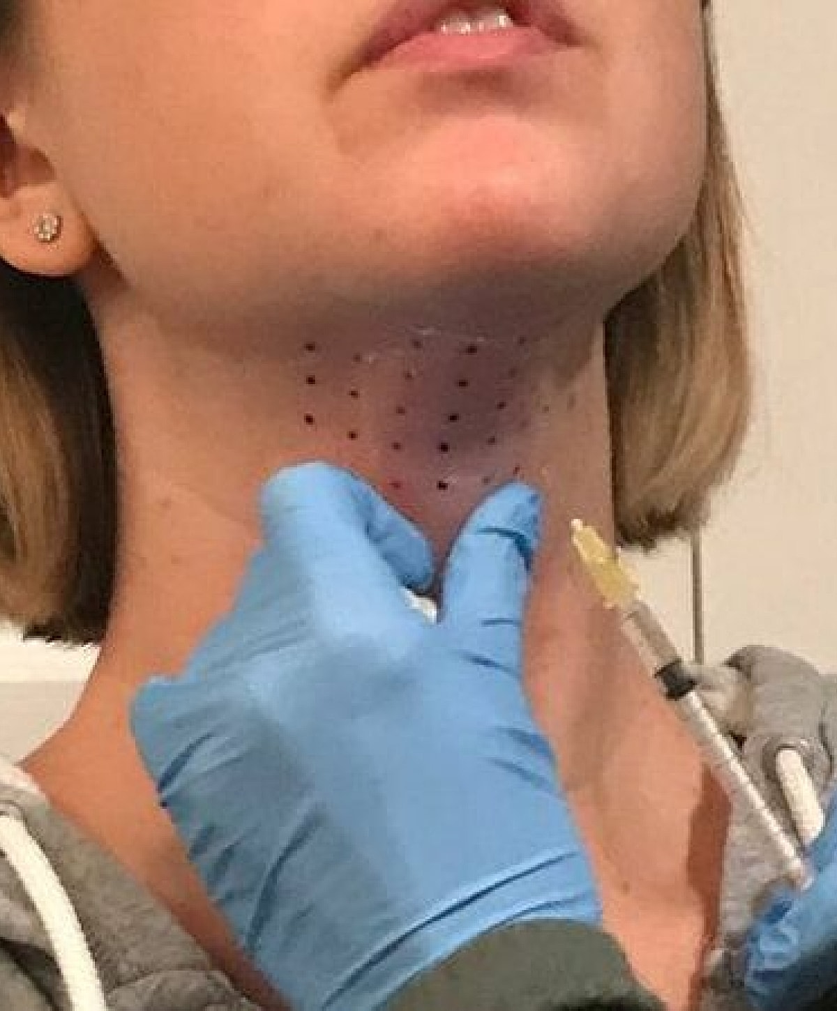 Injecting treatment on a woman's neck.