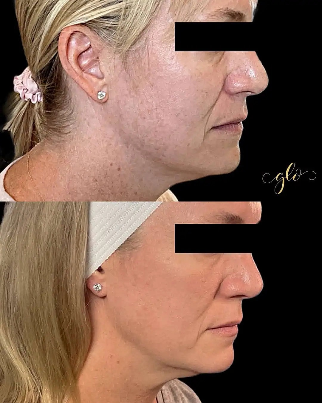 Glo Up Packages at Glo Esthetics in Far Hills, NJ