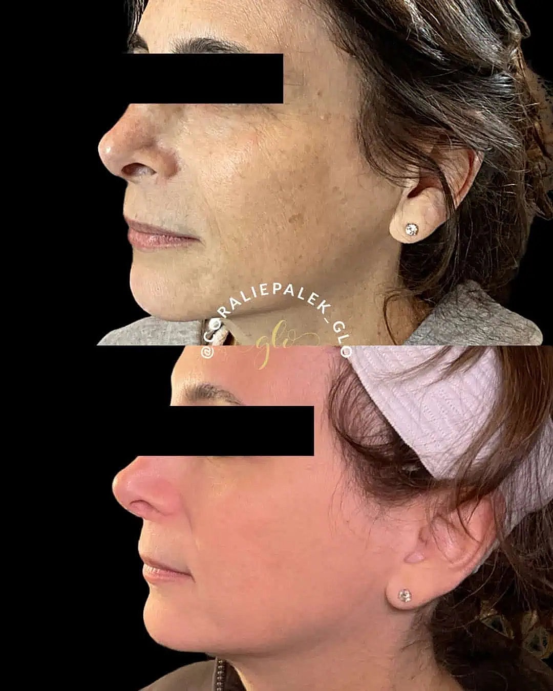 Glo Up Packages at Glo Esthetics in Far Hills, NJ