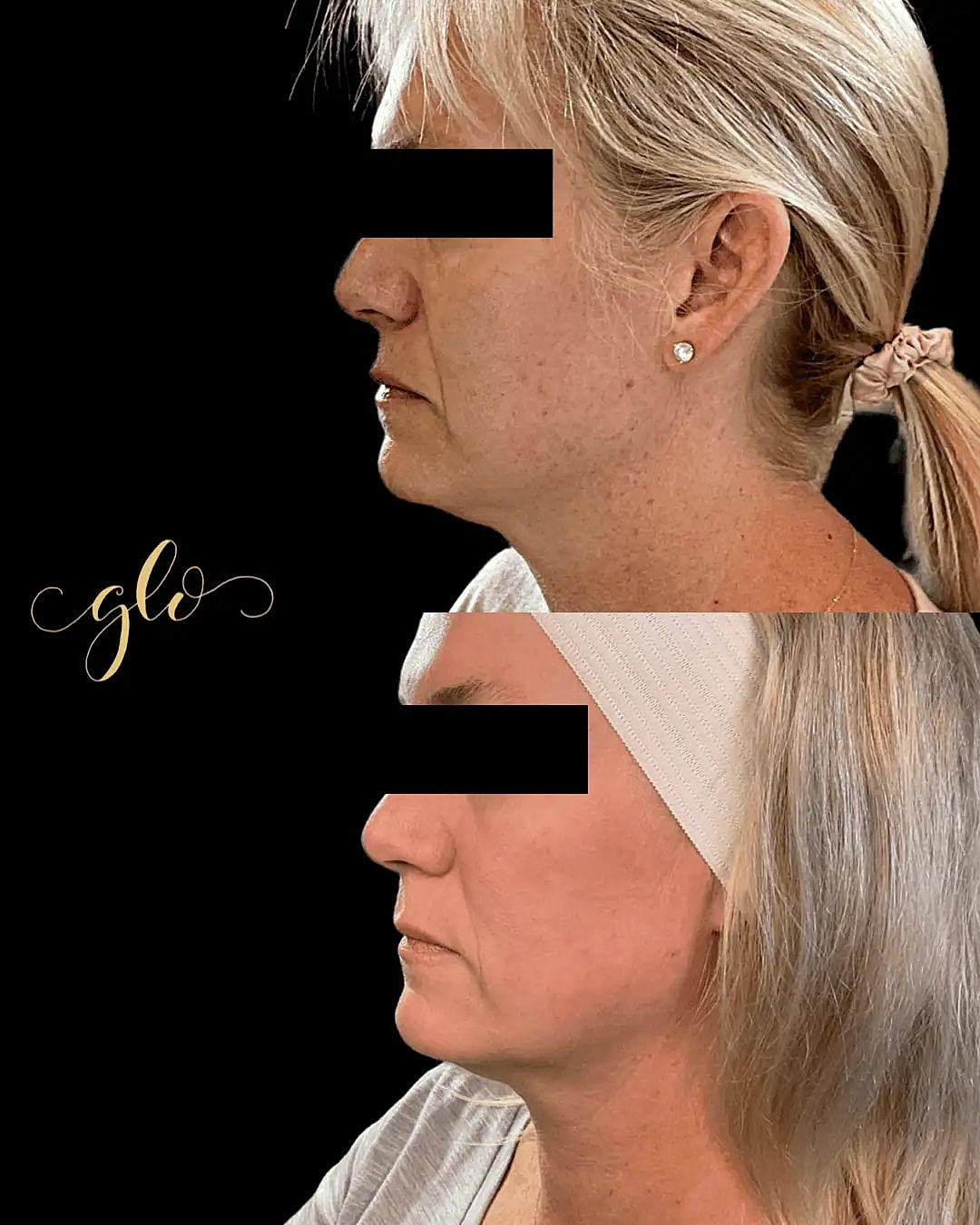 Glo Up Packages at Glo Esthetics in Far Hills, NJ