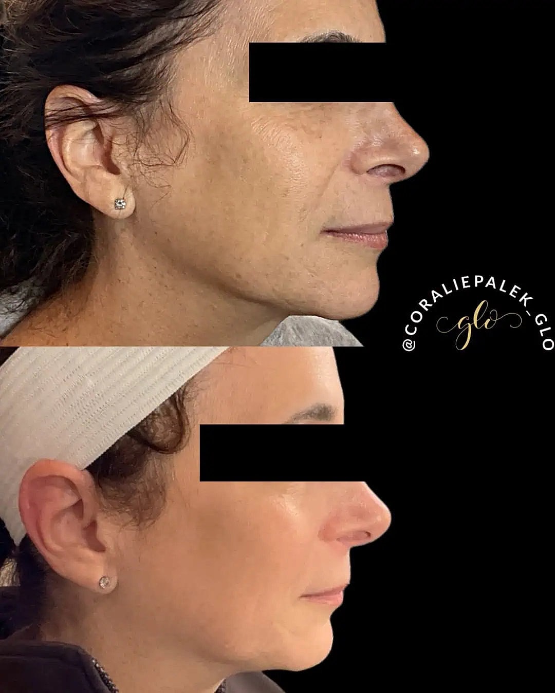 Glo Up Packages at Glo Esthetics in Far Hills, NJ