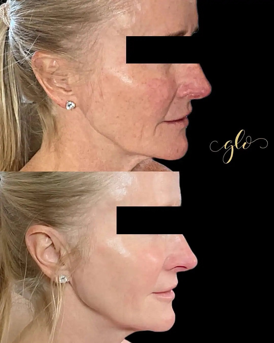 Glo Up Packages at Glo Esthetics in Far Hills, NJ