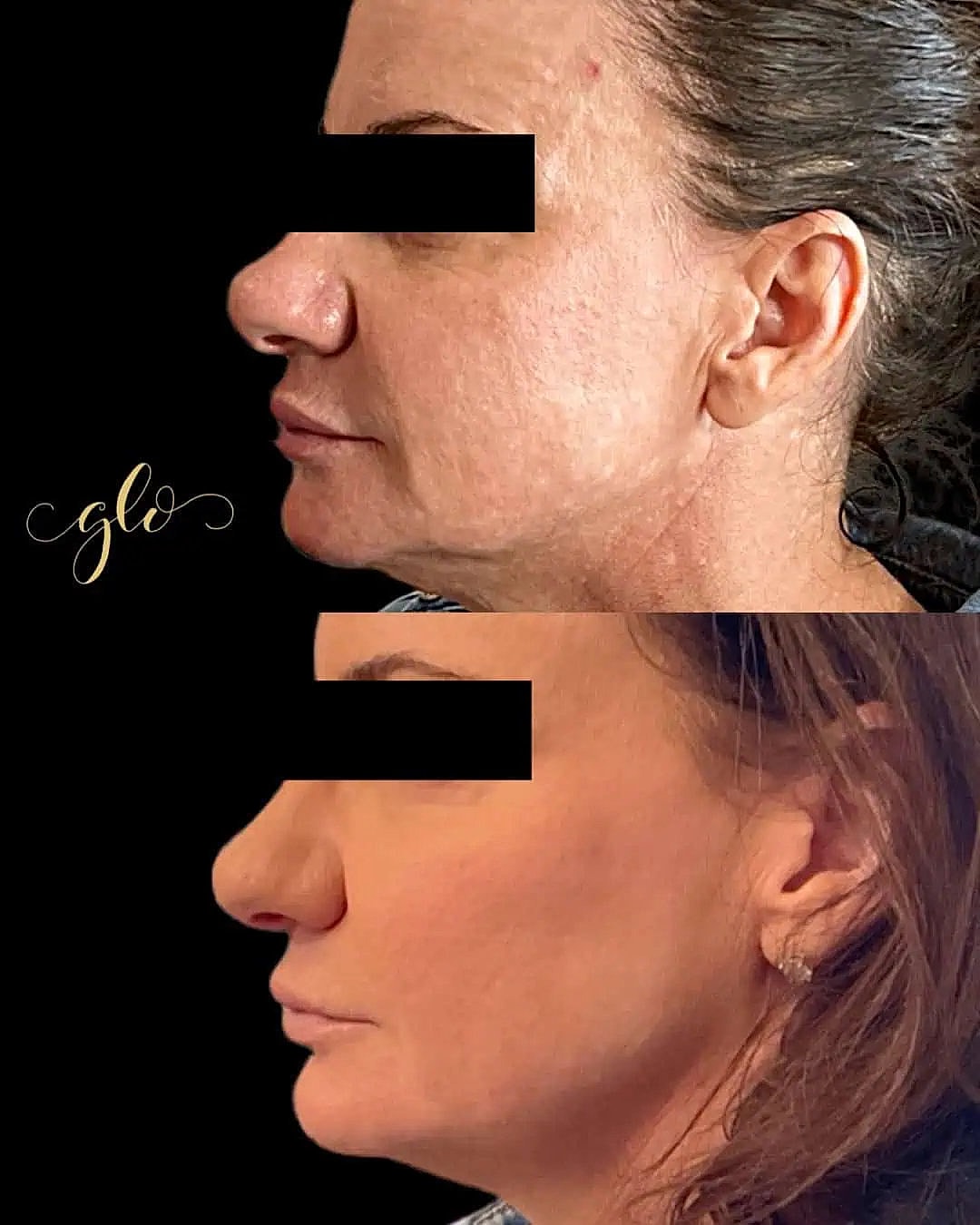 Glo Up Packages at Glo Esthetics in Far Hills, NJ