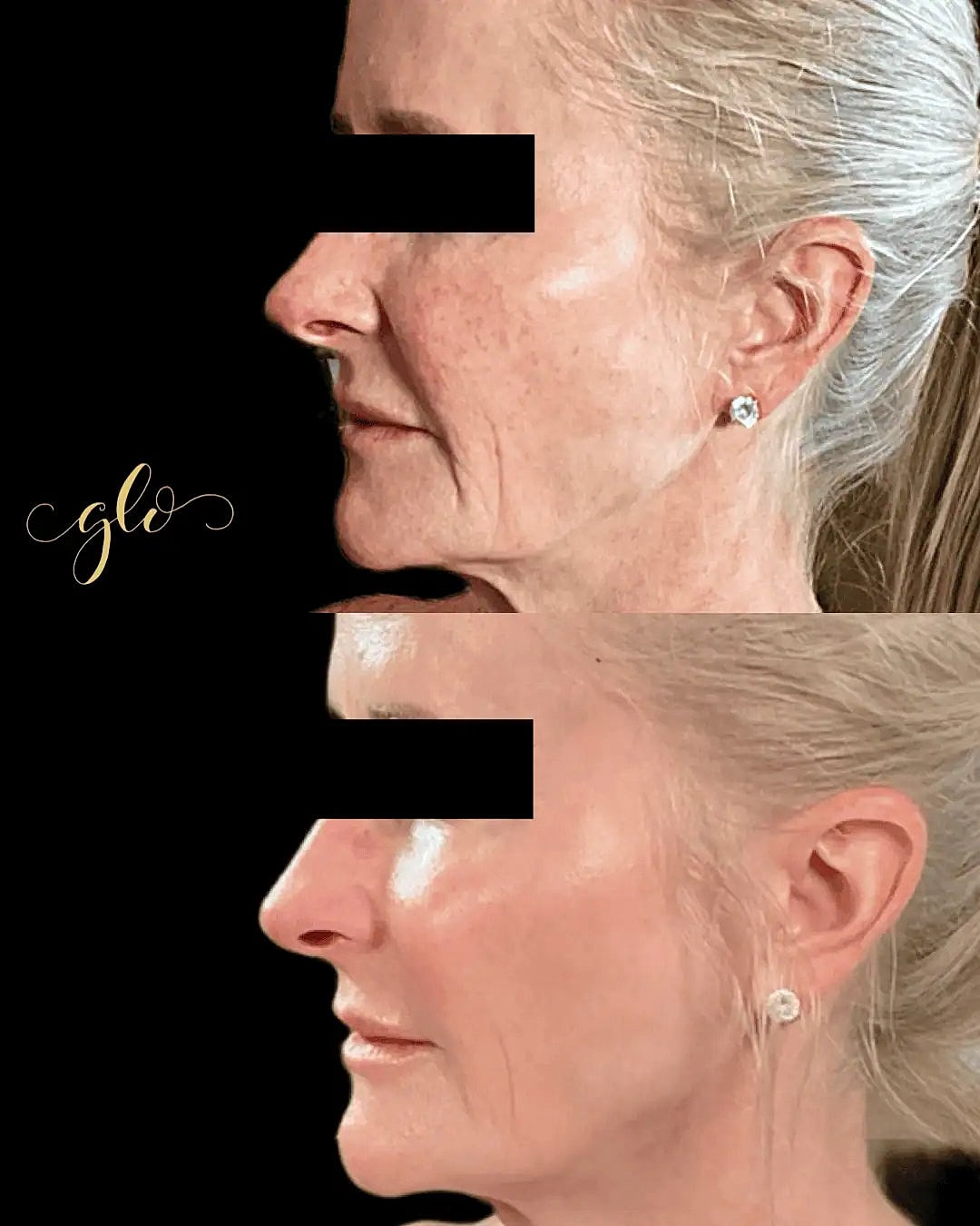 Glo Up Packages at Glo Esthetics in Far Hills, NJ